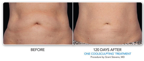 Coolsculpting-Elite-NYC-Manhattan Laser Spa -AfterBefore