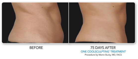 Coolsculpting-Elite-NYC-Manhattan Laser Spa BeforeAfter