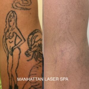 Tattoo Removal in Hallandale Beach, FL 1 Laser tattoo Removal afterbefore manhattan laser spa