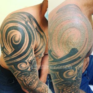 Tattoo Removal in Hallandale Beach, FL 2 Laser tattoo Removal before after manhattan laser spa