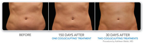 Manhattan laser Spa CoolsculptingElite-NYC-Before-After