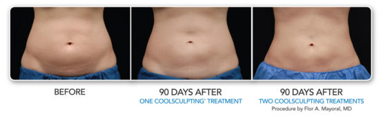 Manhattan laser SpaCoolsculpting-Elite-NYC-Before-After