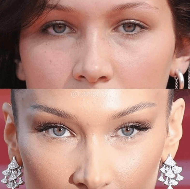 botox browlift before after 1