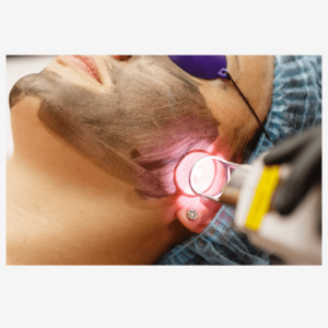 carbon laser peel hollywood image facial 1