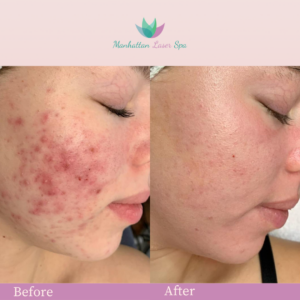 nyc after before images acne removal manhattan laser spa