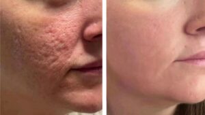 Acne Scar Treatment in Hollywood, FL 3 2 1