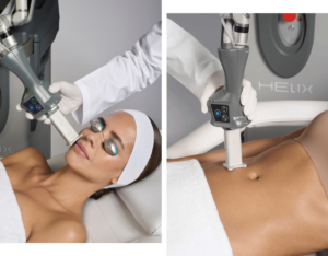 Helix Fusion being used on stomach and face