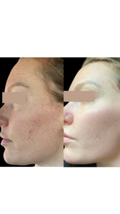 Acne Scar Treatment in Hollywood, FL 4 results