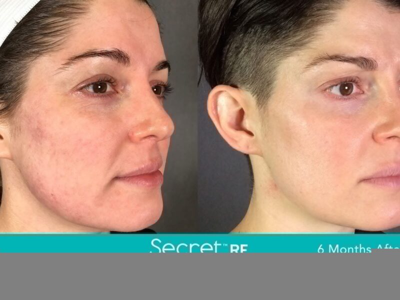 Before-&-After_Images_RF-Microneedling-service_manhattanlaserspa