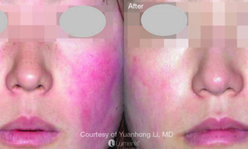 Before & After_The Lumenis® M22 IPL-service_images_manhattanlaserspa-one