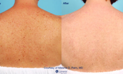 Before & After_The Lumenis® M22 IPL-service_images_manhattanlaserspa-two