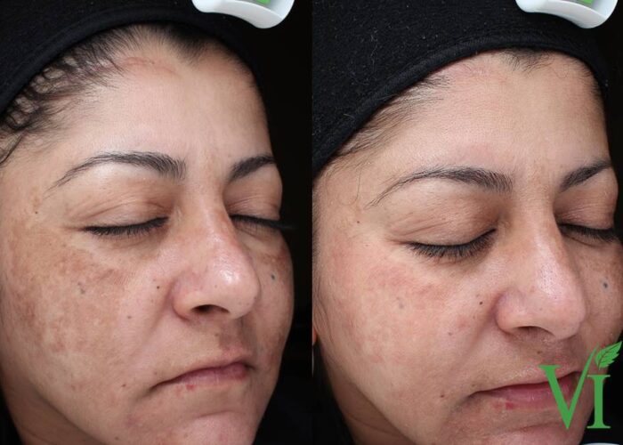 Melasma_Before & After_Images_VI Peel-service_manhattanlaserspa