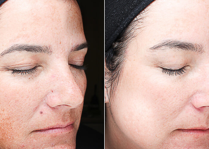 Pigmentation_Before & After_Images_VI Peel-service_manhattanlaserspa